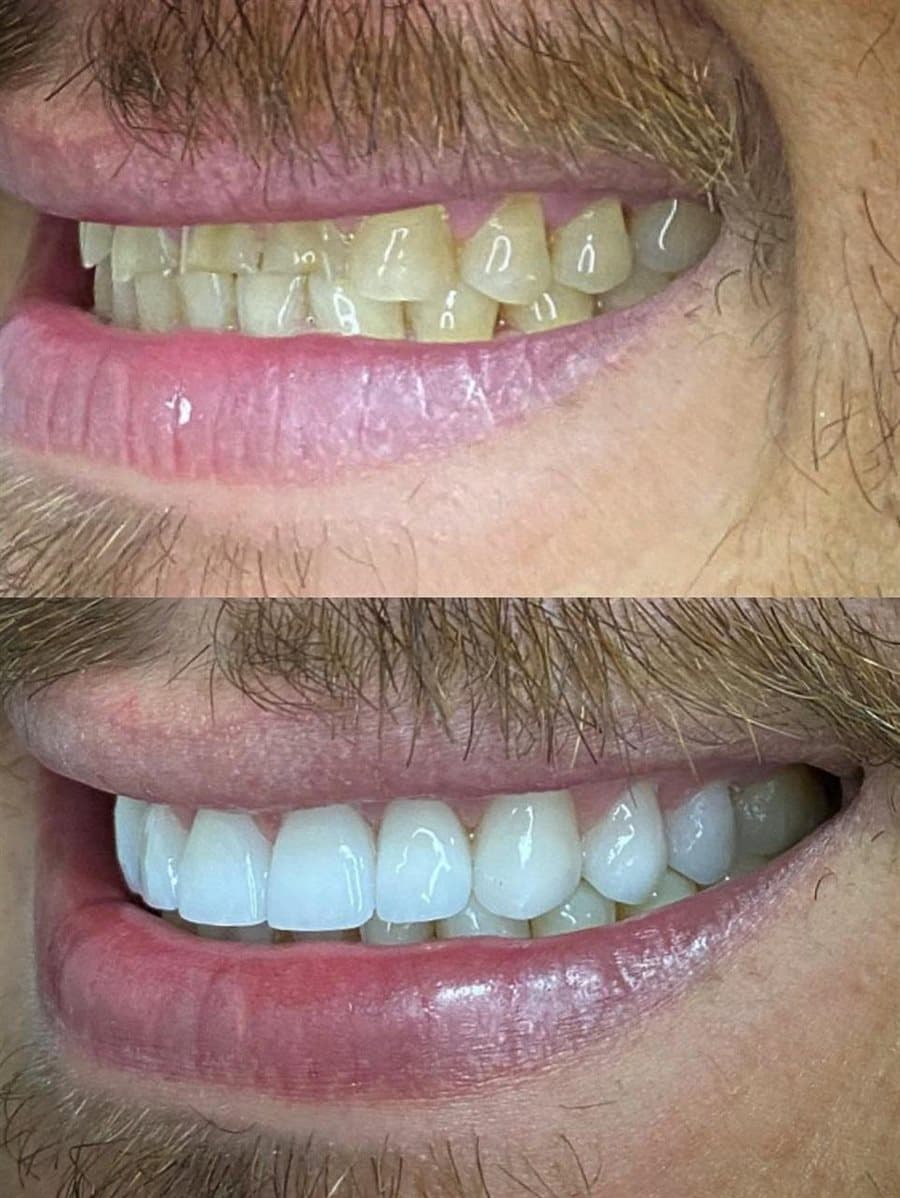 Antes e depois — Lentes de contato