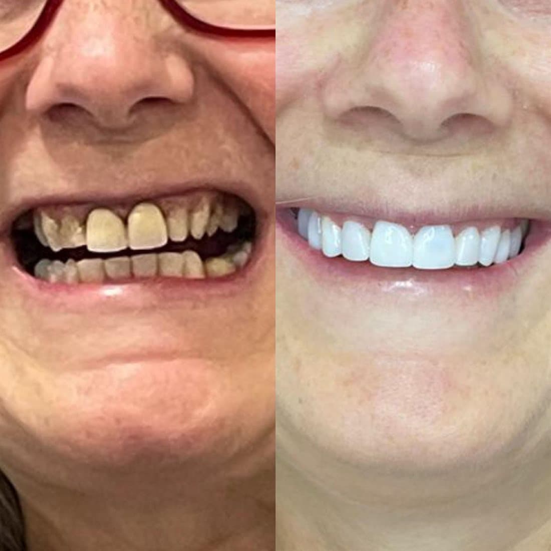 Antes e depois — Lentes de contato