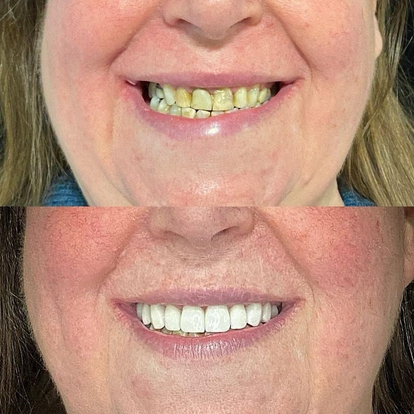 Antes e depois — Lentes de contato