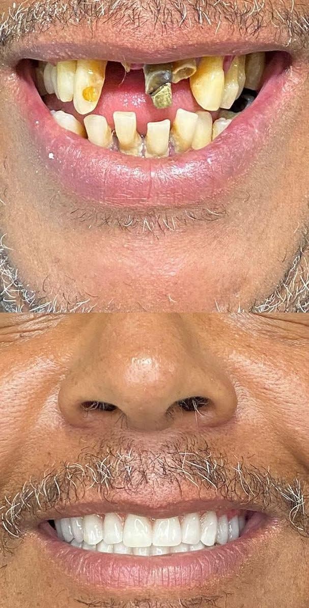 Antes e depois — Prótese protocolo